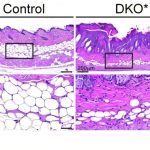 psoriasis-study-shows