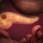 Reconstructed-Image-of-Pancreatic-Adenocarcinoma