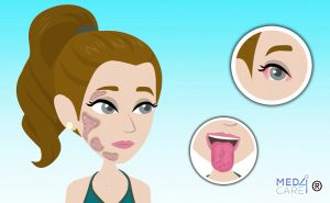 Sindrome-di-Sjogren-Article-Thumbnail-Size-1