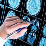 demenza-senile-e-morbo-di-alzheimer