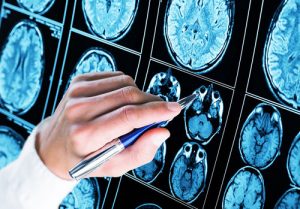 demenza-senile-e-morbo-di-alzheimer