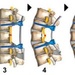 hope-for-spinal-injuri