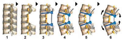 hope-for-spinal-injuri