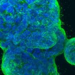 breast-cancer-4 (2)