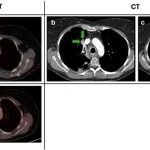 lung-cancer-patient-be
