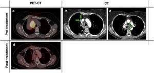 lung-cancer-patient-be