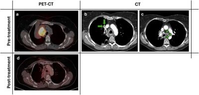 lung-cancer-patient-be