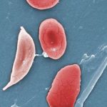 1-sicklecelldi