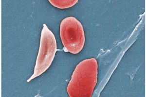 1-sicklecelldi