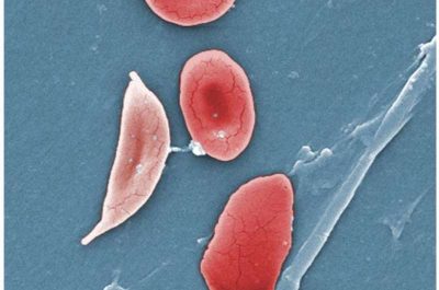 1-sicklecelldi