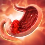 Stomach-Gastric-Cancer-1200x800