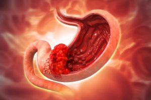 Stomach-Gastric-Cancer-1200x800