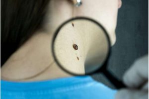 melanoma-vaccine-reduc