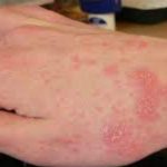 scabbia_mano