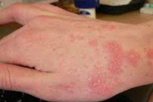 scabbia_mano